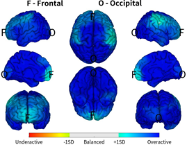🧠 QEEG NÓI GÌ VỀ TÌNH TRẠNG NÃO BỘ CỦA BẠN?