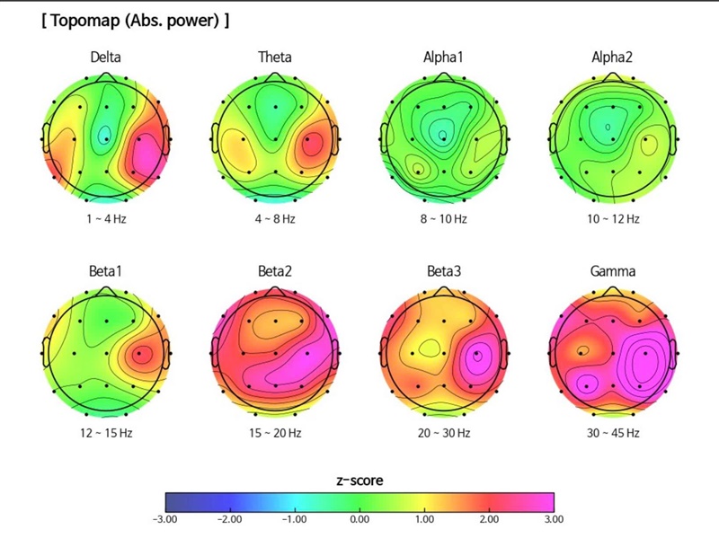 🧠 5 LOẠI SÓNG NÃO & NHỮNG VẤN ĐỀ SỨC KHỎE BẠN ĐANG GẶP PHẢI