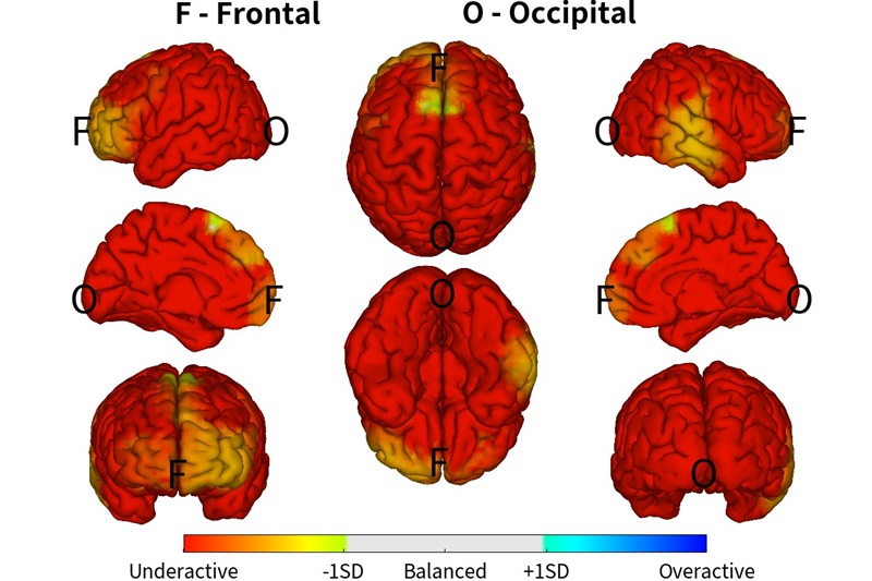 🧠 CASE THỰC TẾ: 10 NĂM LOẠN THẦN – TÂM THẦN PHÂN LIỆT NÃO ĐANG Ở TRẠNG THÁI BÁO ĐỘNG